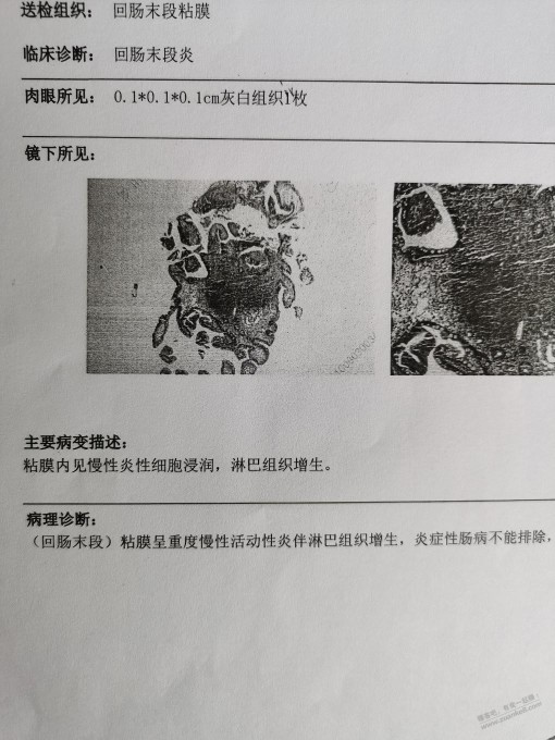 年前的体检单，这个肠息肉需要做手术吗？